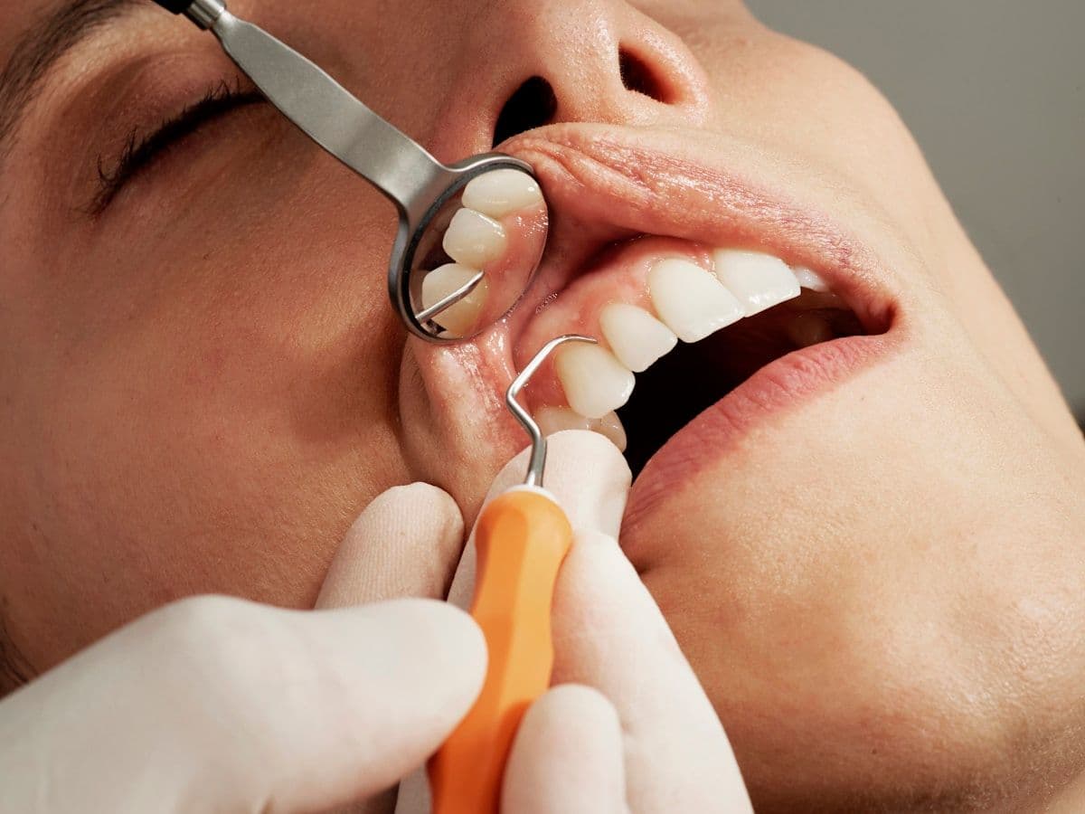 Professional teeth whitening